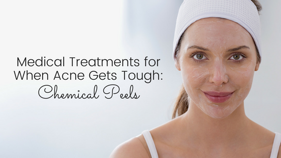 Medical Treatments for When Acne Gets Tough – Part 1